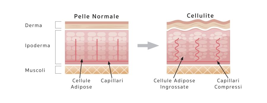 Schema cellulite