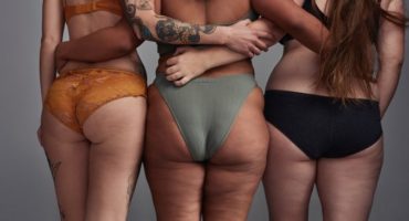 Tipologie cellulite donne